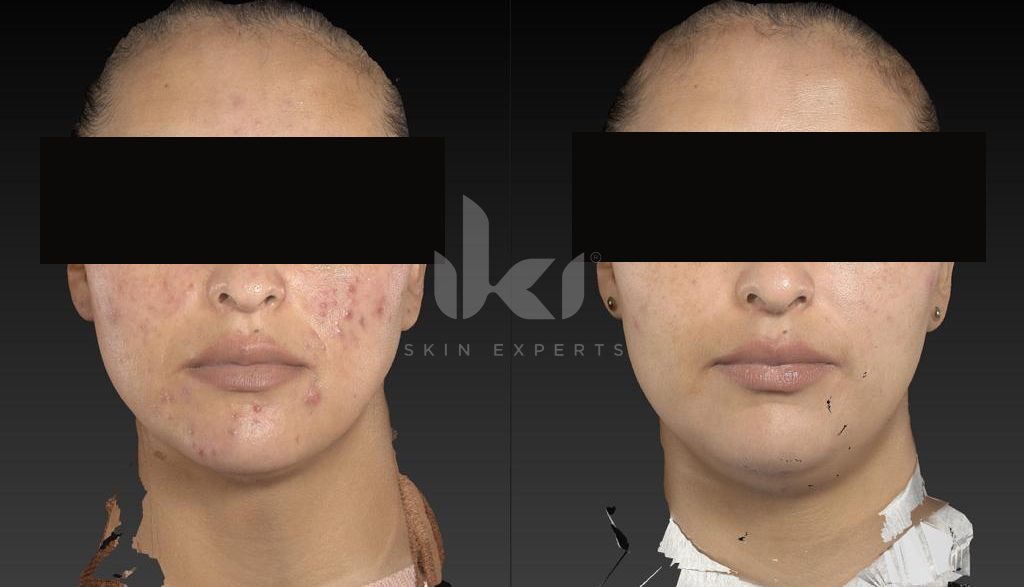 Antes y después de acné en IKI Skin Experts, caso 1, identidad protegida
