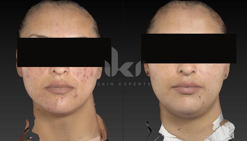Antes y después de acné en IKI Skin Experts, caso 2, identidad protegida