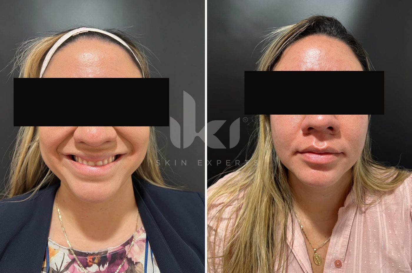 Antes y después de toxina botulínica en IKI Skin Experts, caso 3, identidad protegida