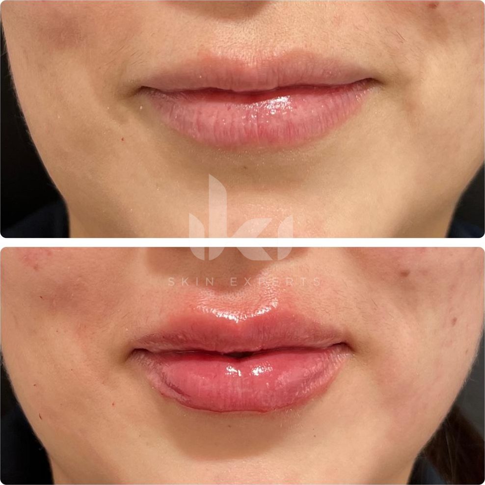 Antes y después de labios en IKI Skin Experts, caso 2, identidad protegida