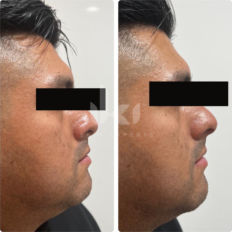 Antes y después de labios en IKI Skin Experts, caso 3, identidad protegida