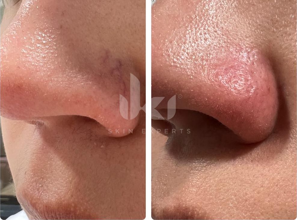 Antes y después de rosácea en IKI Skin Experts, caso 1, identidad protegida
