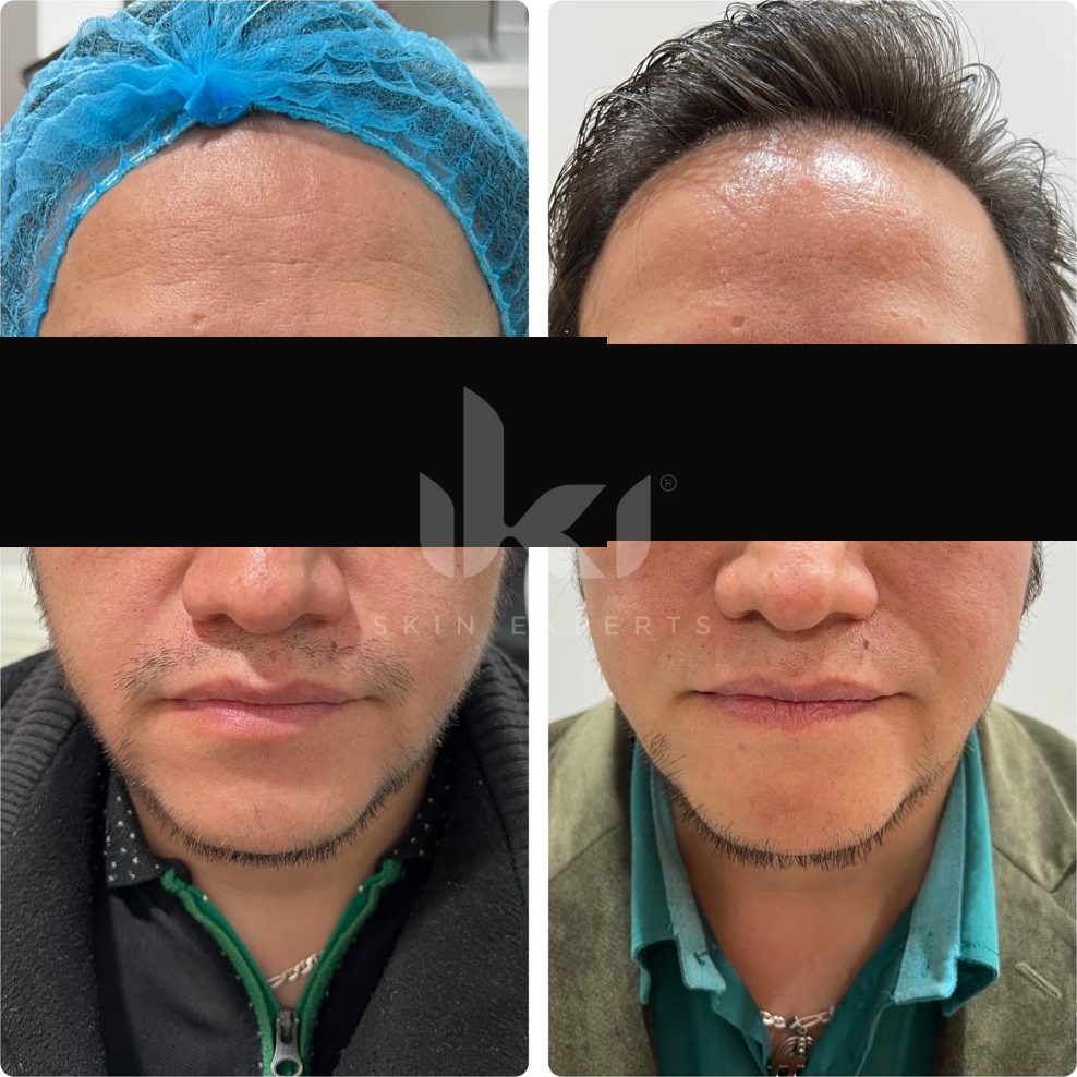 Antes y después de labios en IKI Skin Experts, caso 4, identidad protegida