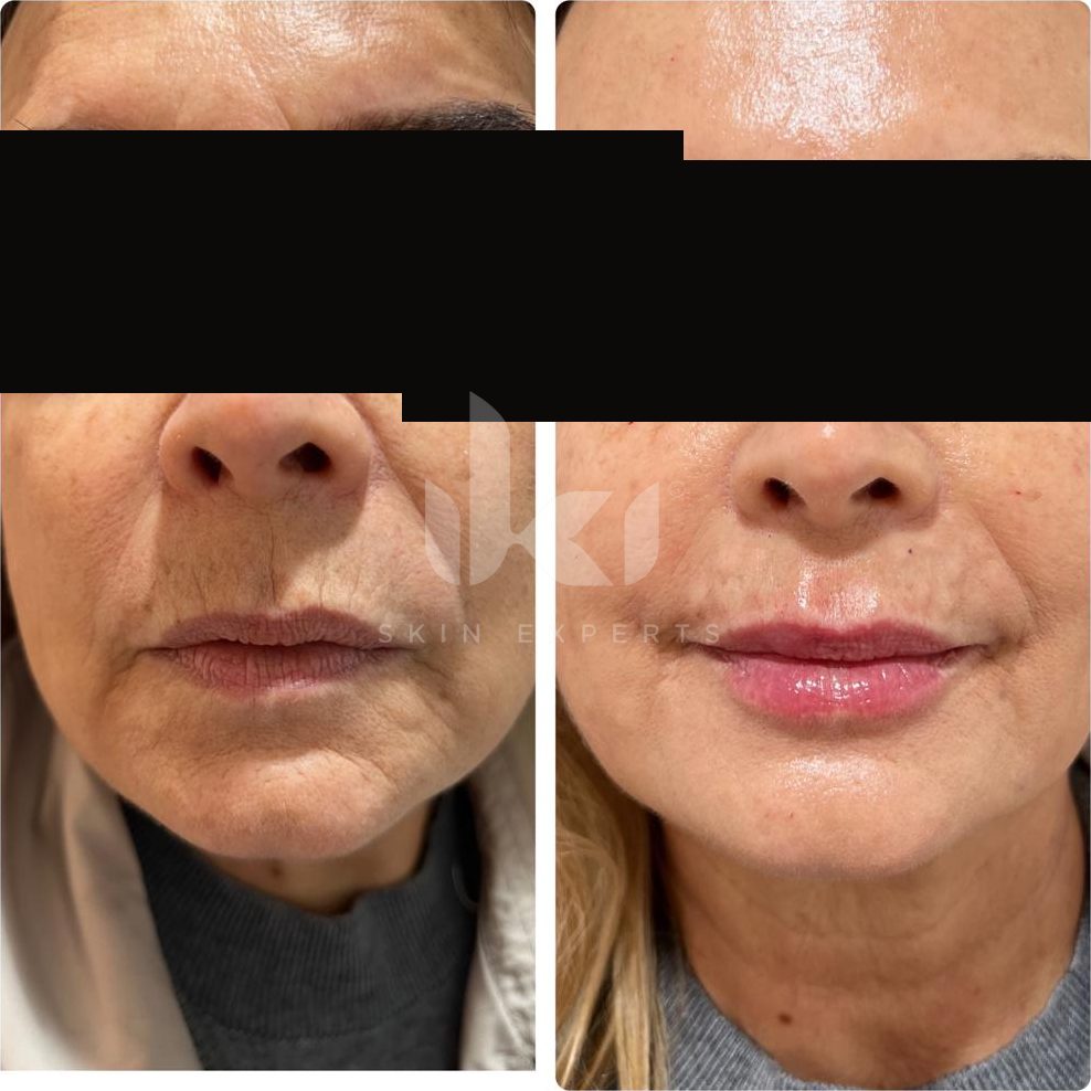 Antes y después de labios en IKI Skin Experts, caso 5, identidad protegida