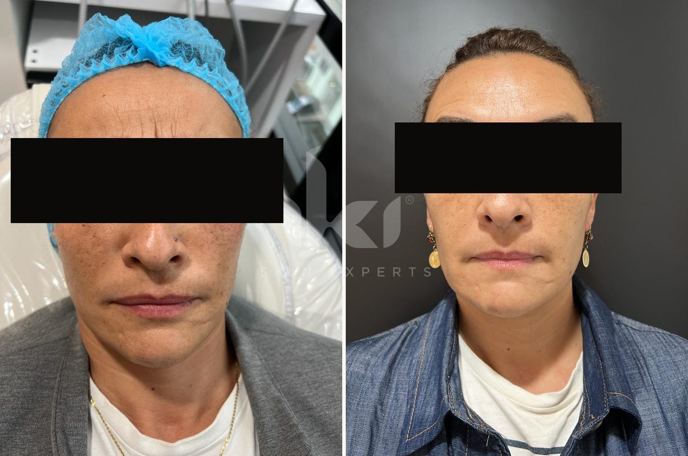 Antes y después de toxina botulínica en IKI Skin Experts, caso 5, identidad protegida