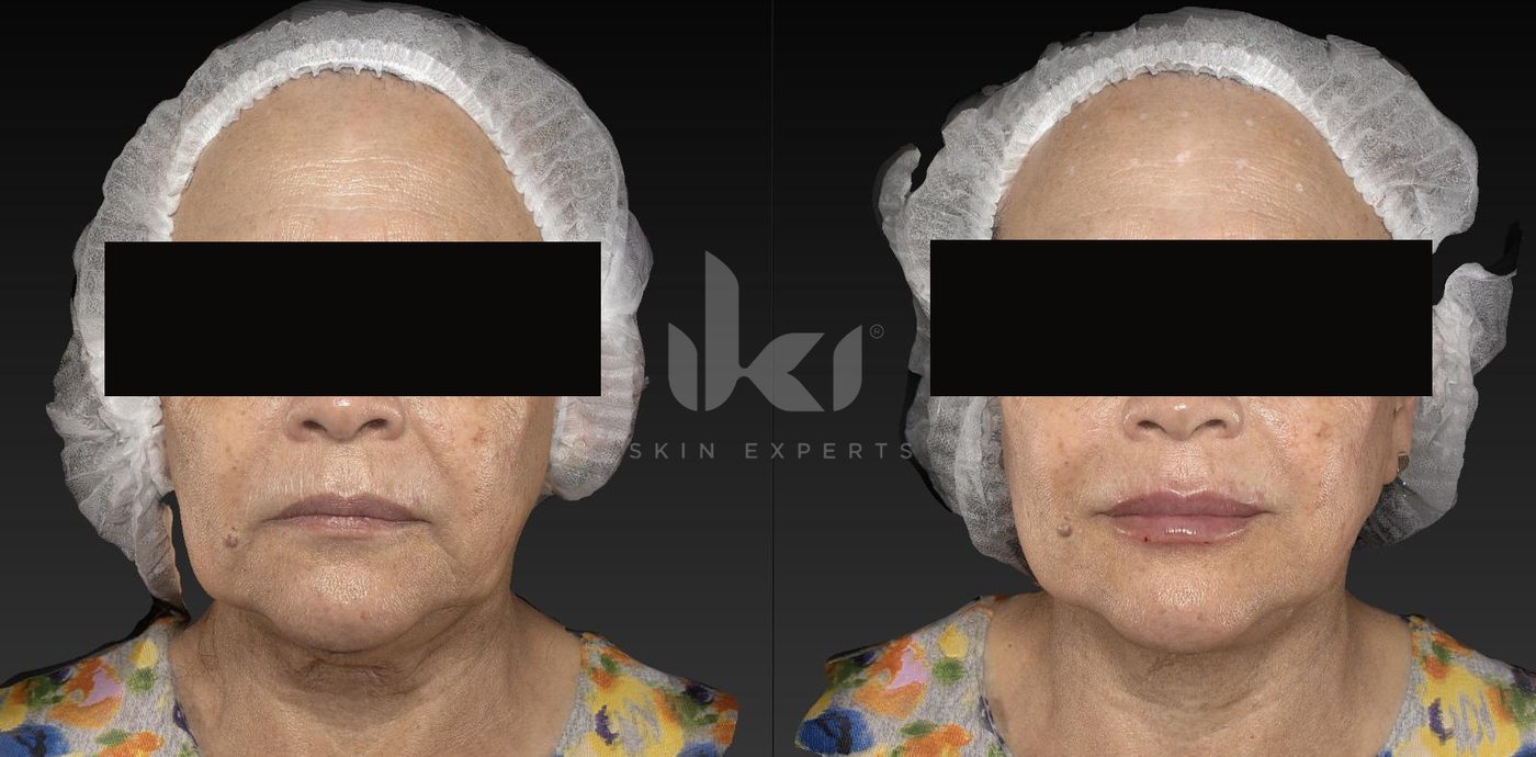 Antes y después de labios en IKI Skin Experts, caso 6, identidad protegida