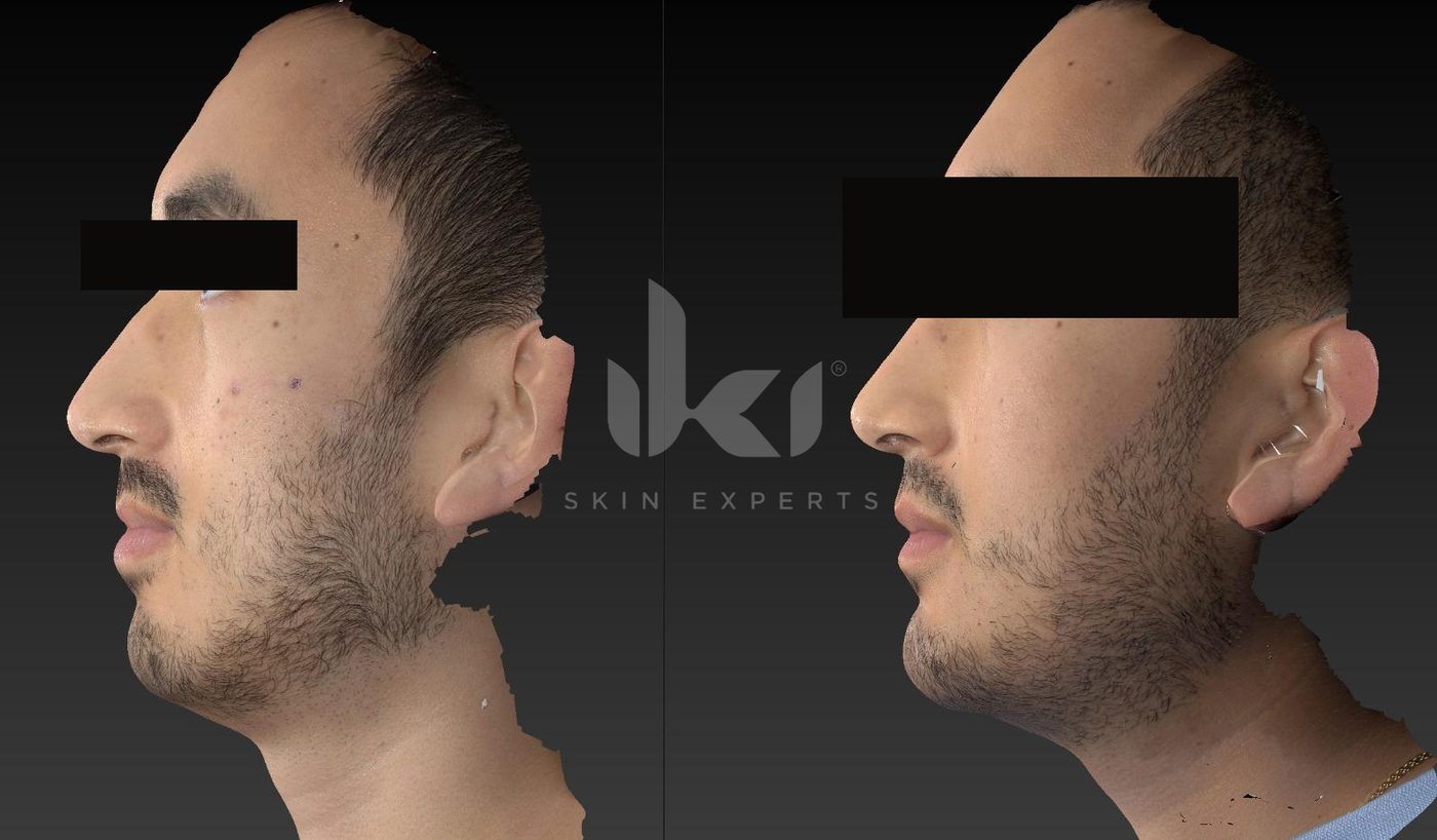 Antes y después de acné en IKI Skin Experts, caso 7, identidad protegida