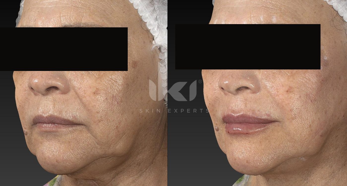Antes y después de labios en IKI Skin Experts, caso 7, identidad protegida