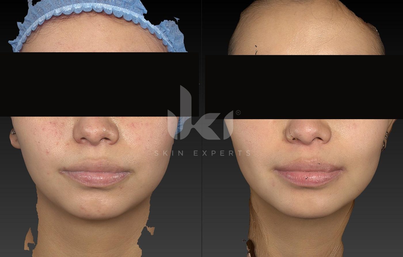 Antes y después de acné en IKI Skin Experts, caso 9, identidad protegida