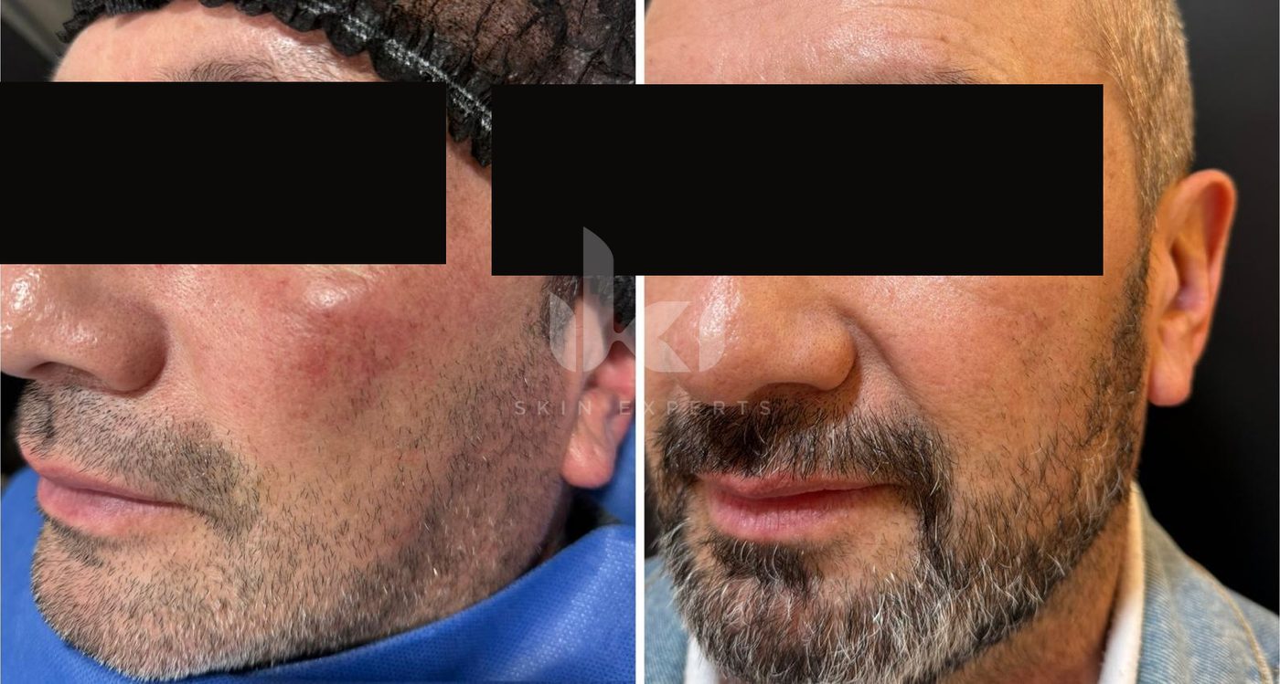 Antes y después de rosácea en IKI Skin Experts, caso 8, identidad protegida