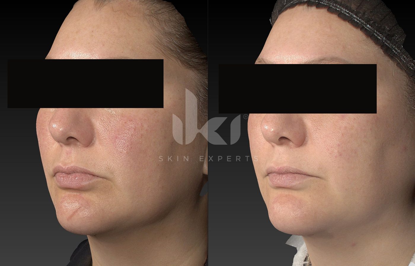 Antes y después de rosácea en IKI Skin Experts, caso 11, identidad protegida