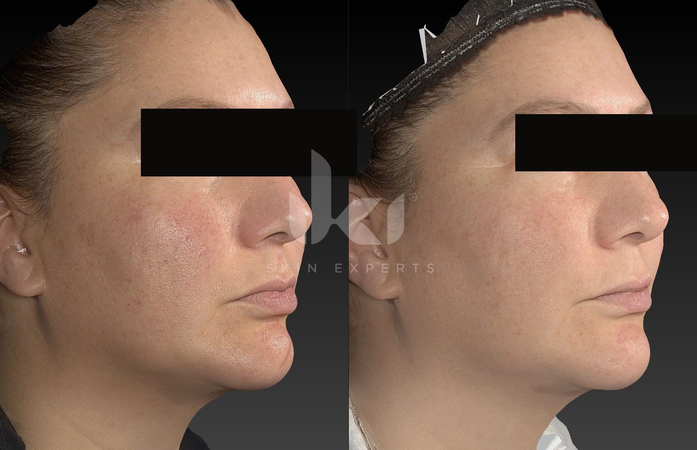 Antes y después de rosácea en IKI Skin Experts, caso 12, identidad protegida