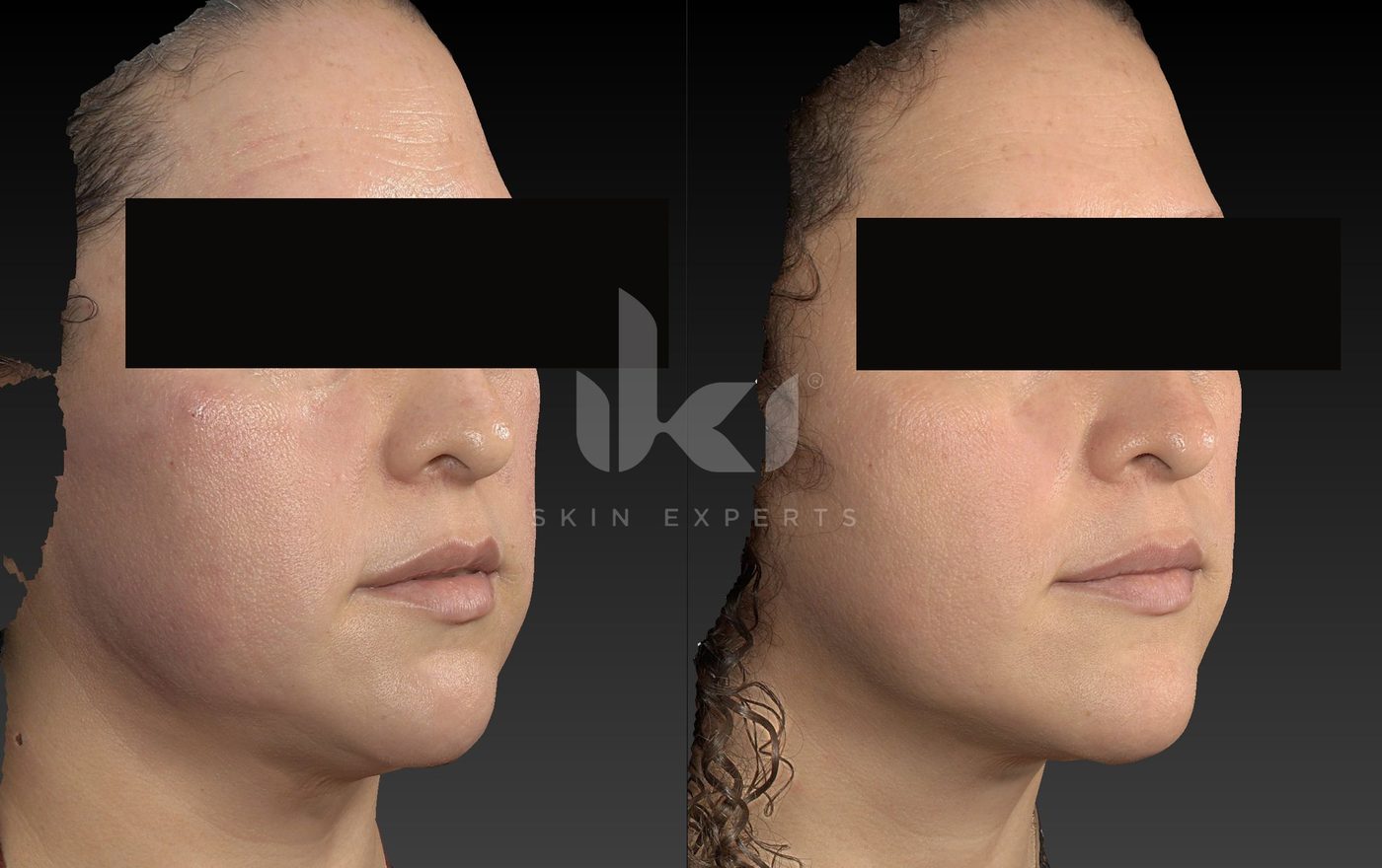 Antes y después de rosácea en IKI Skin Experts, caso 13, identidad protegida