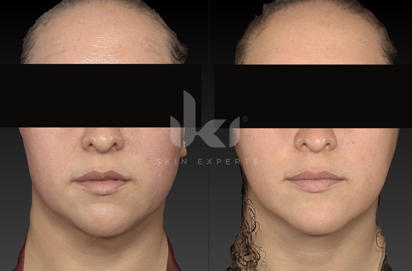 Antes y después de rosácea en IKI Skin Experts, caso 14, identidad protegida