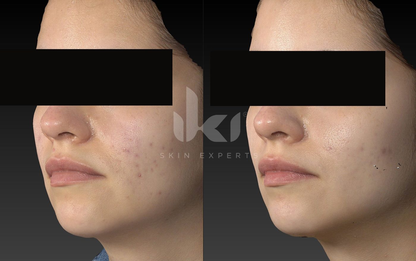 Antes y después de acné en IKI Skin Experts, caso 13, identidad protegida