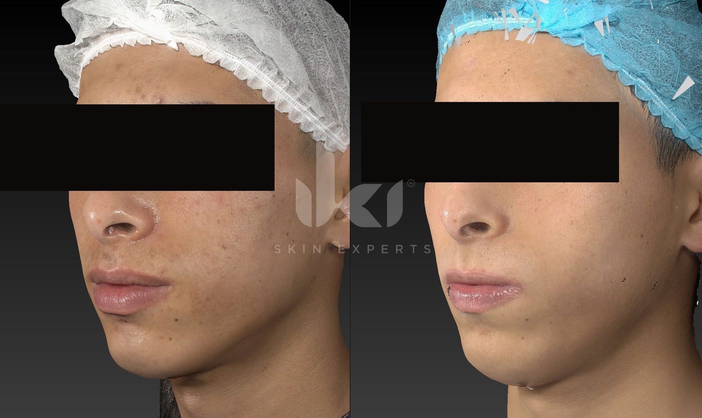 Antes y después de acné en IKI Skin Experts, caso 18, identidad protegida